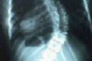 Apariencia de columna con escoliosis.